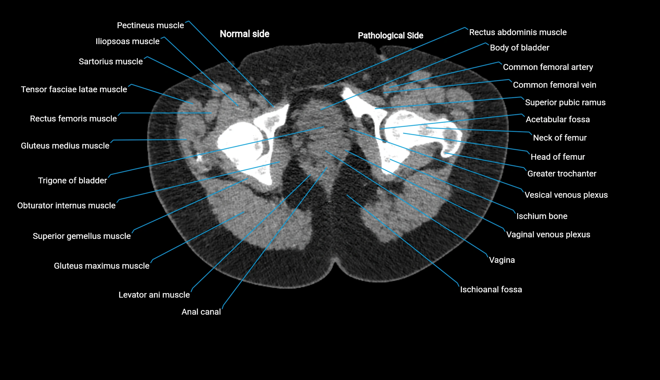 CT KUB axial cross sectional anatomy  radiology image -img-00201-00165.webp